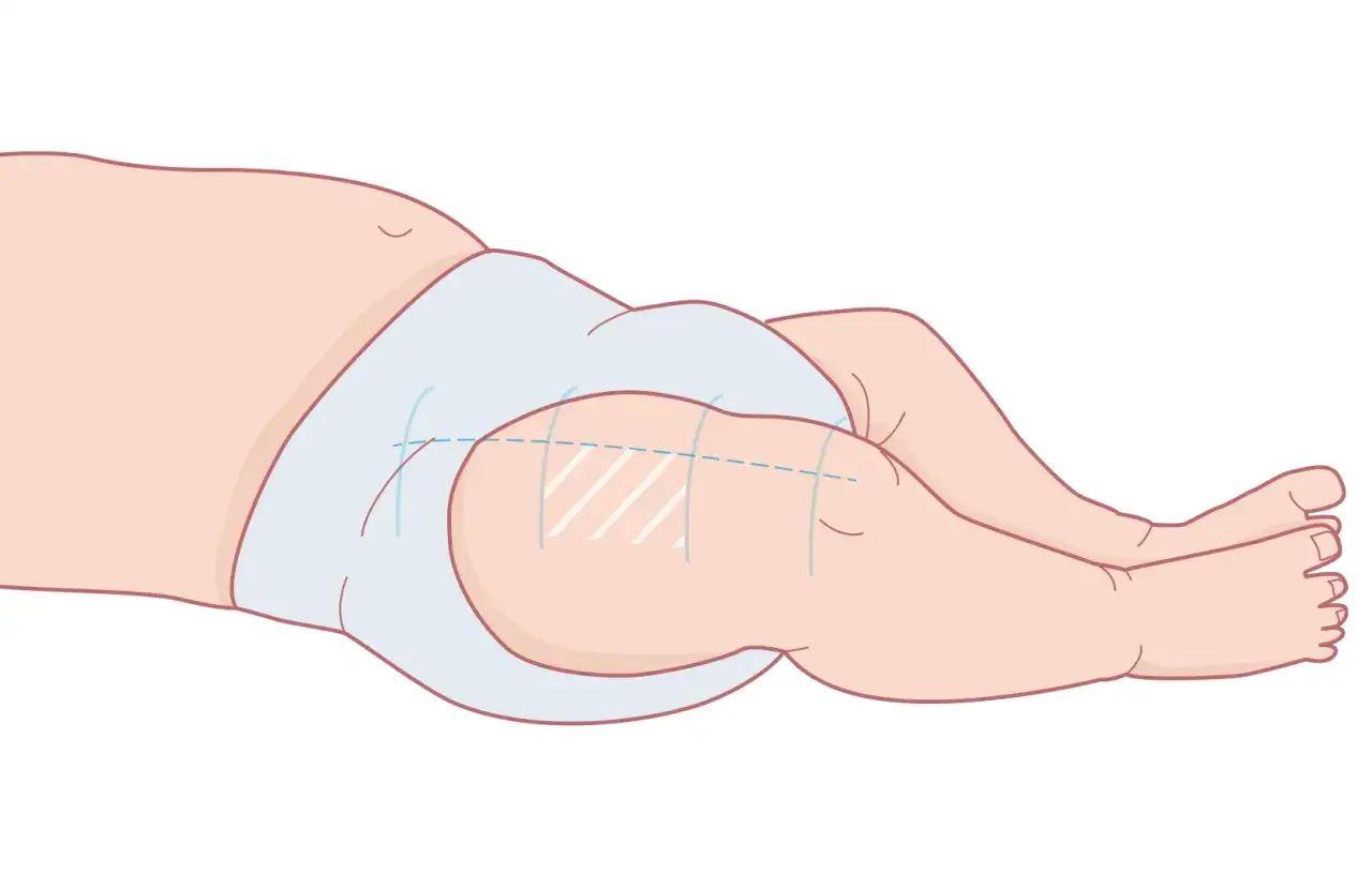 Illustration av ett barns l&aring;r med en ljusbl&aring; bl&ouml;ja. Markeringar p&aring; l&aring;ret indikerar var 3 m&aring;naders vaccin ges.