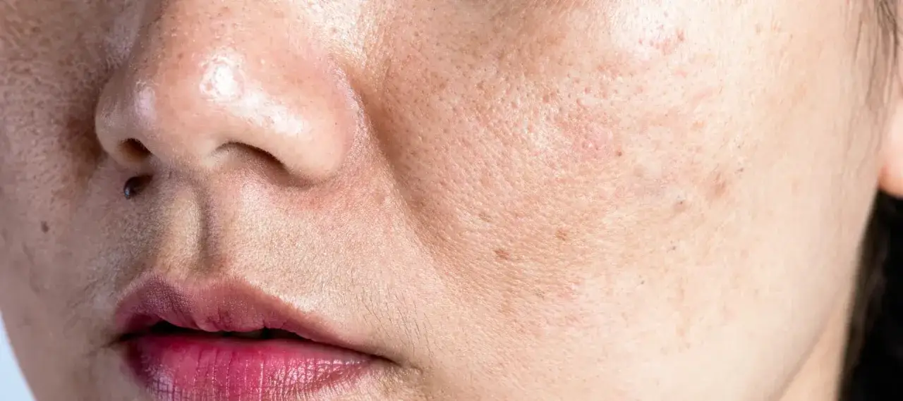 Gros plan sur une peau du visage avec des pores dilat&eacute;s, des taches brunes et une l&eacute;g&egrave;re **peau qui p&egrave;le** pr&egrave;s des l&egrave;vres.