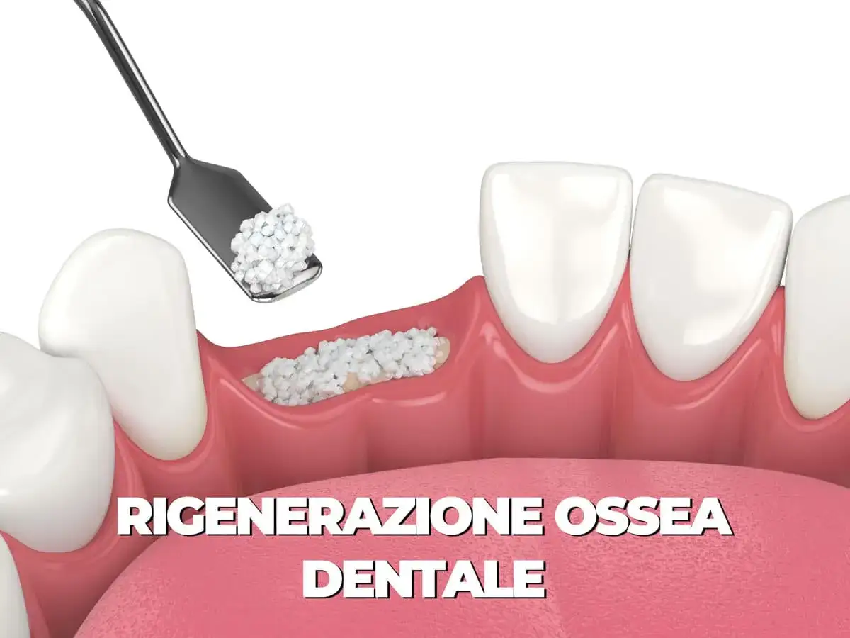 Strumento deposita materiale per innesto osseo dentale in un alveolo vuoto, promuovendo la rigenerazione ossea.