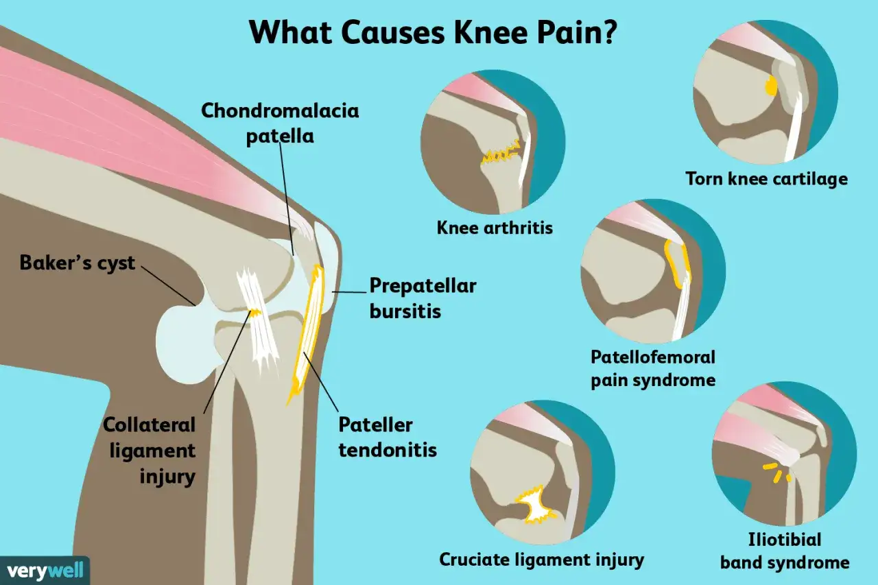Illustration zeigt Ursachen für stechenden Schmerz im Knie: Baker-Zyste, Bänderverletzung, Knorpelschaden, Arthritis, Patellaprobleme.