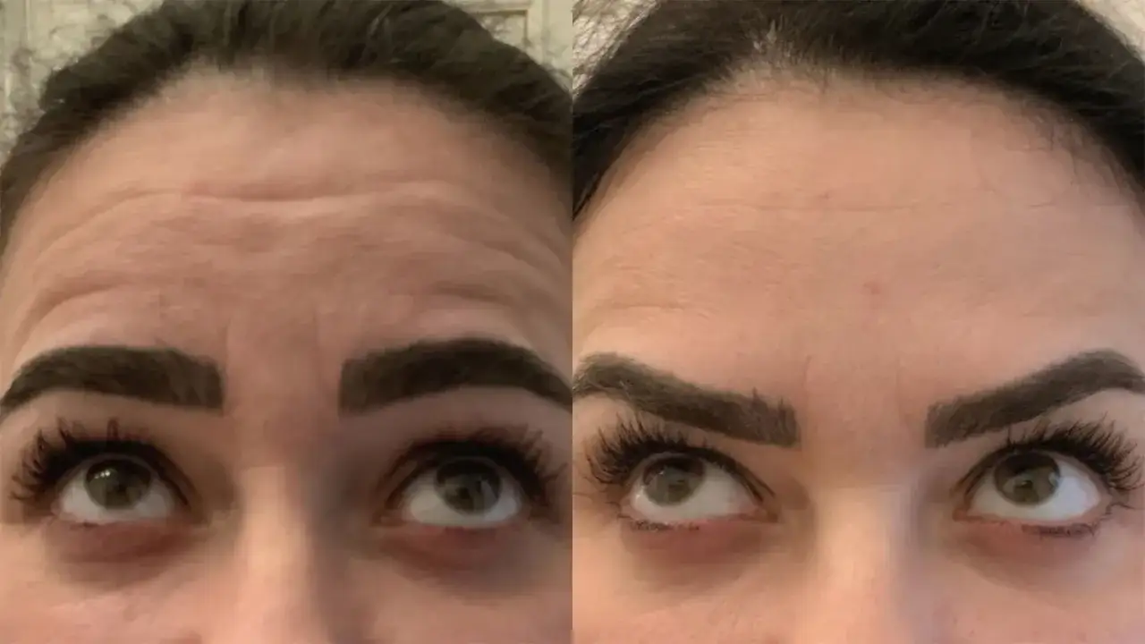 Före- och efterbilder visar en slätare panna efter hårbotox.