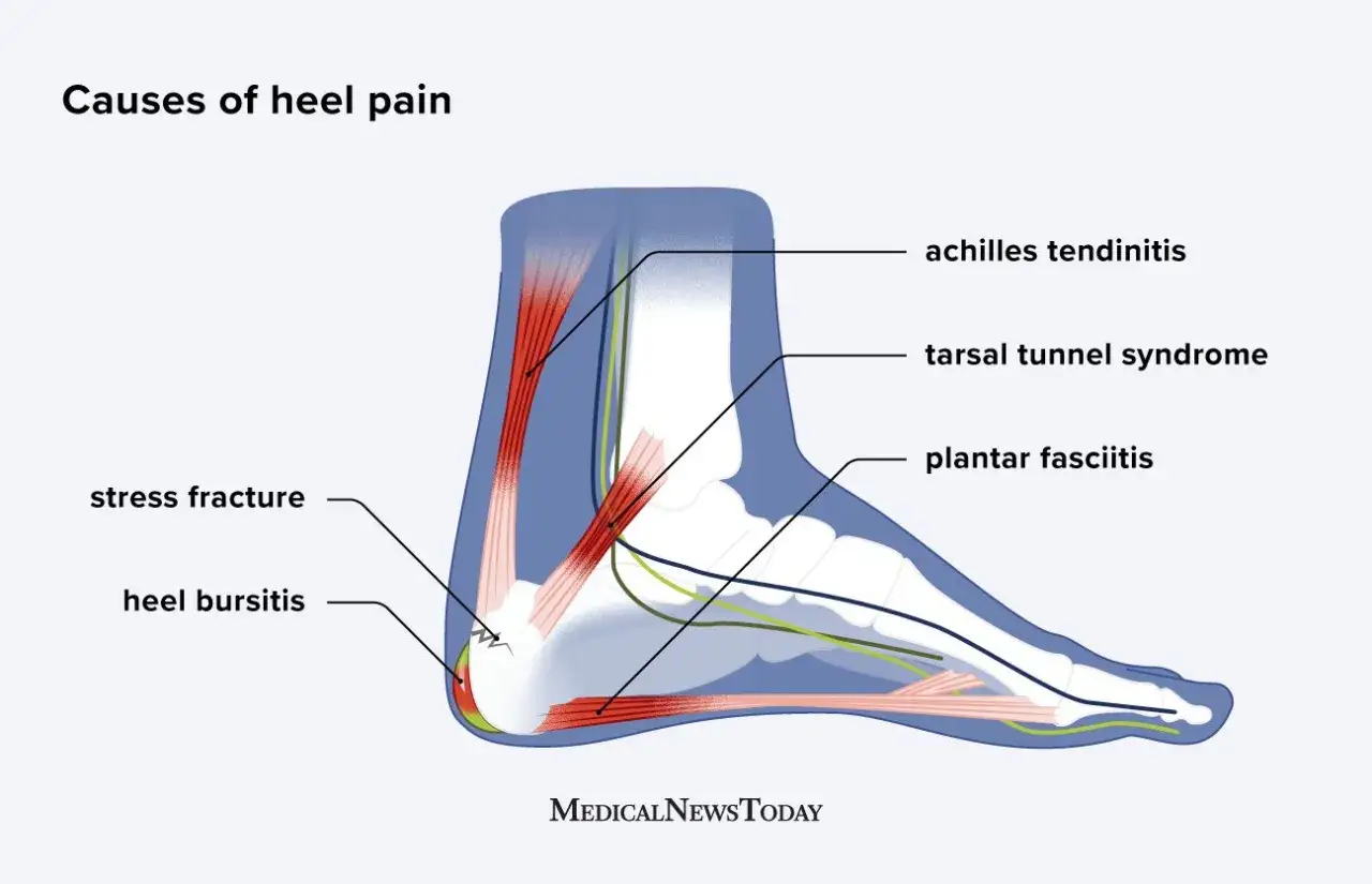 Illustration der Calcaneus-Anatomie mit Ursachen f&uuml;r Fersenschmerzen: Achillessehnenentz&uuml;ndung, Tarsaltunnelsyndrom, Plantarfasziitis, Stressfraktur, Fersen bursitis.