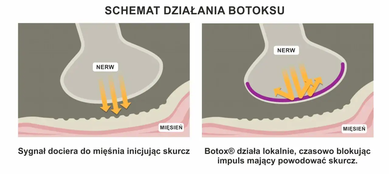 mechanizm działania botoksu na mięśnie