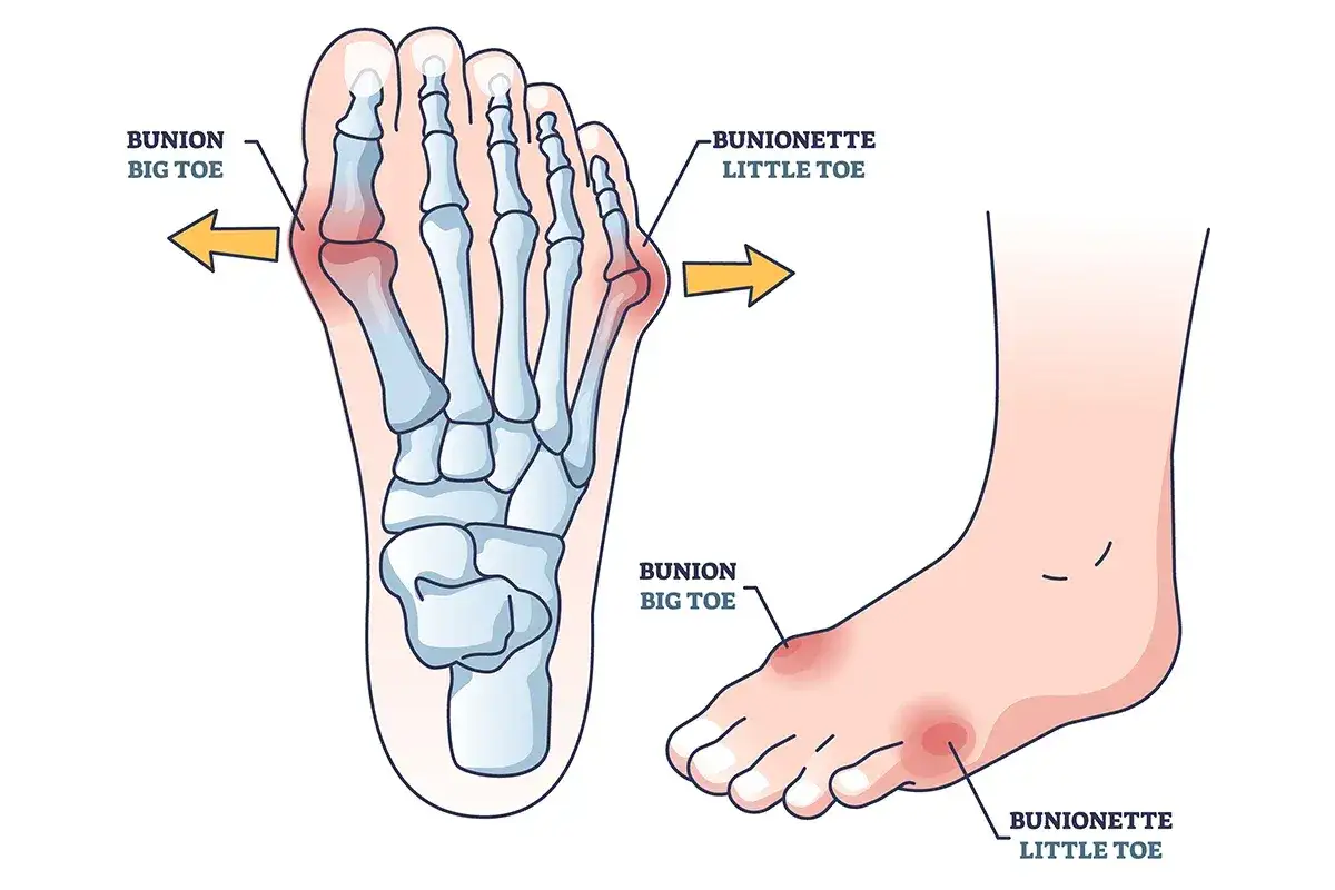 Illustration av fotens skelett och utsida som visar hallux valgus inflammation vid stortåns bas och en bunionette vid lillfingret.