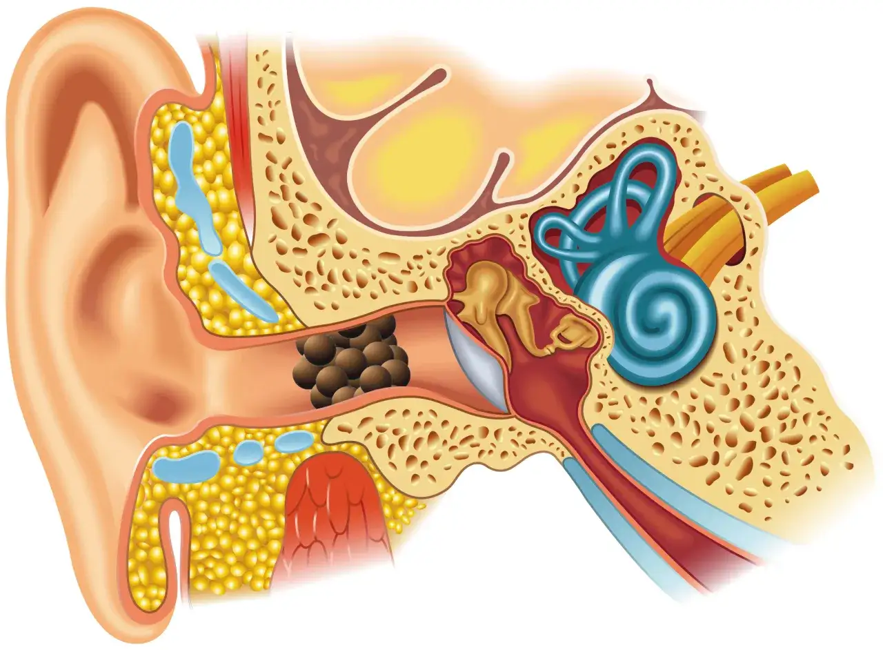 Anatomie de l'oreille montrant un bouchon d'oreille et les structures impliquées dans les vertiges.