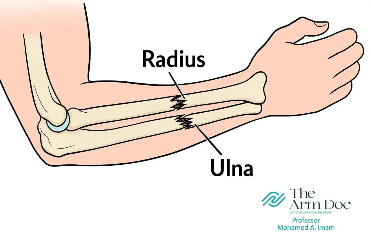 Złamane kości przedramienia: radius i ulna. Ilustracja pokazuje złamania obu kości.