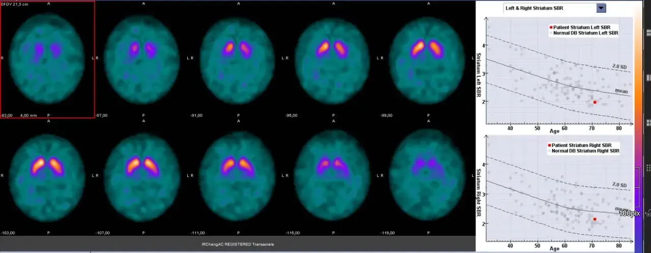 DaT-Scan Gehirn Parkinson