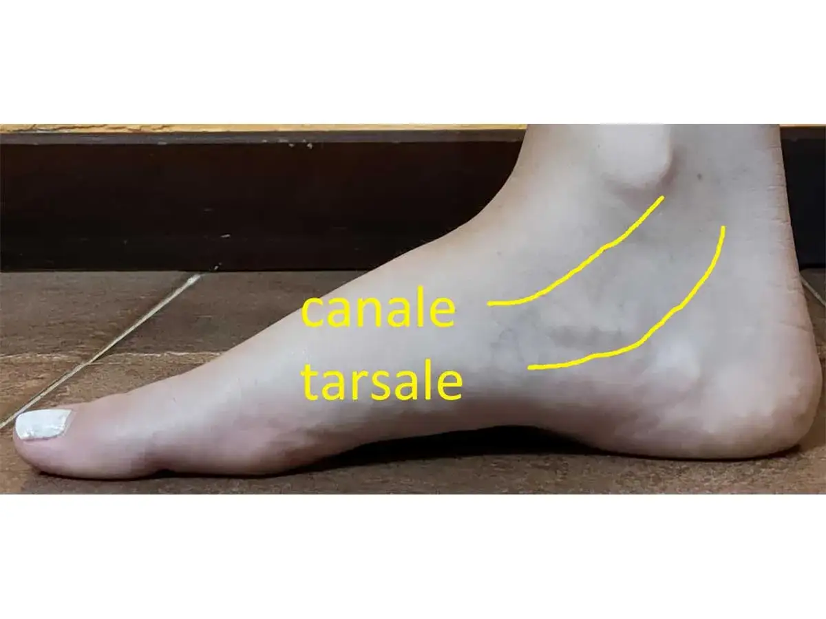 Piede con evidenziato il canale tarsale, area spesso interessata da dolore al malleolo interno.