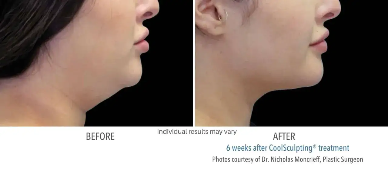 Przed i po zabiegu CoolSculpting. Widoczne spektakularne kriolipoliza efekty w redukcji podbródka.