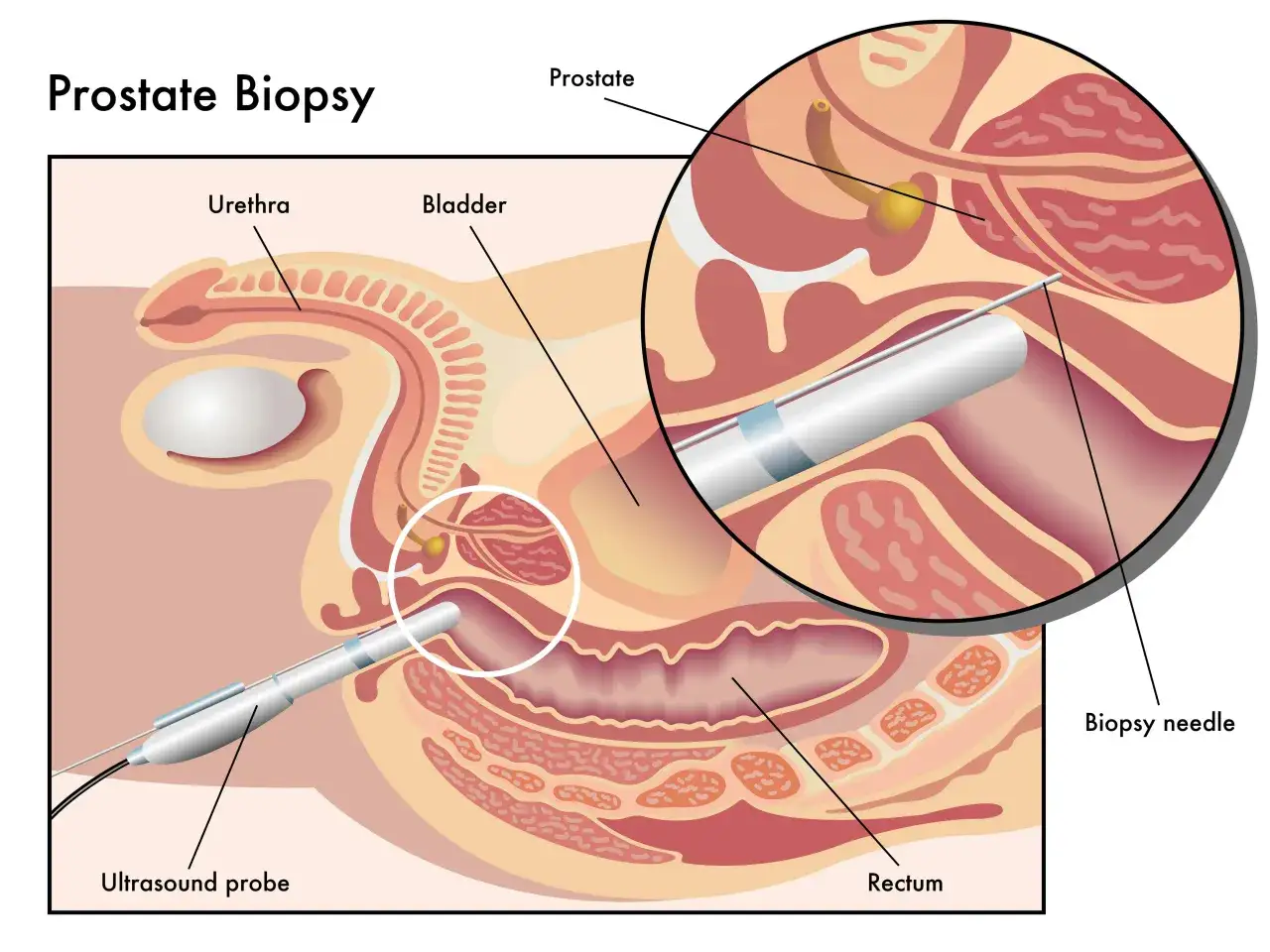 Ilustracja pokazuje biopsję prostaty. Pytanie, czy biopsja prostaty może uaktywnić raka, jest często zadawane.