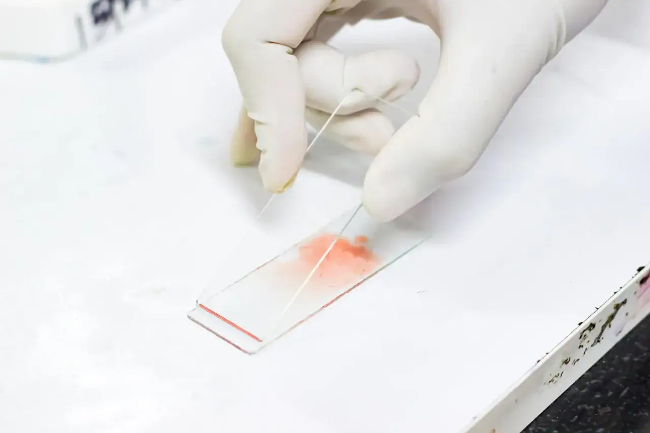 Mani guantate preparano un vetrino per analizzare globuli rossi alterati, forse indicativi di anemia megaloblastica.