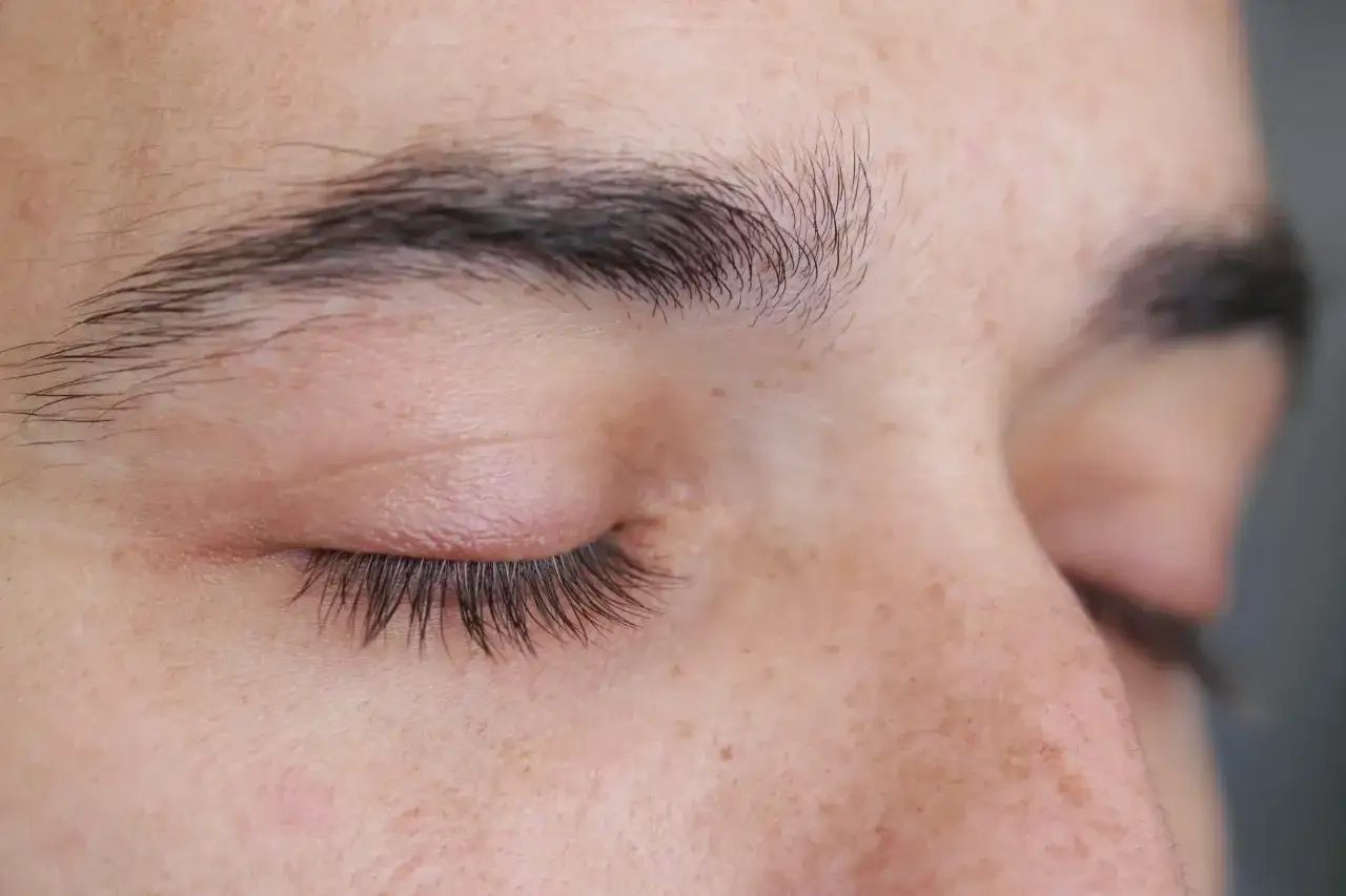 Gros plan sur un &oelig;il ferm&eacute;, montrant des rougeurs et des squames sur la paupi&egrave;re, sympt&ocirc;mes d'un psoriasis paupi&egrave;re.