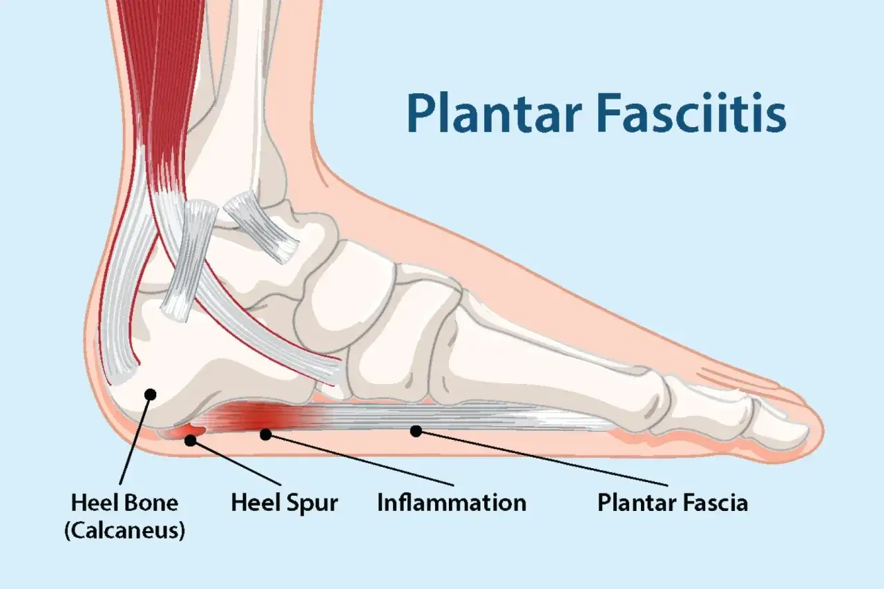 Illustration av fotens anatomi som visar plantar fasciit symtom: hälsporre, inflammation och plantar fascia.