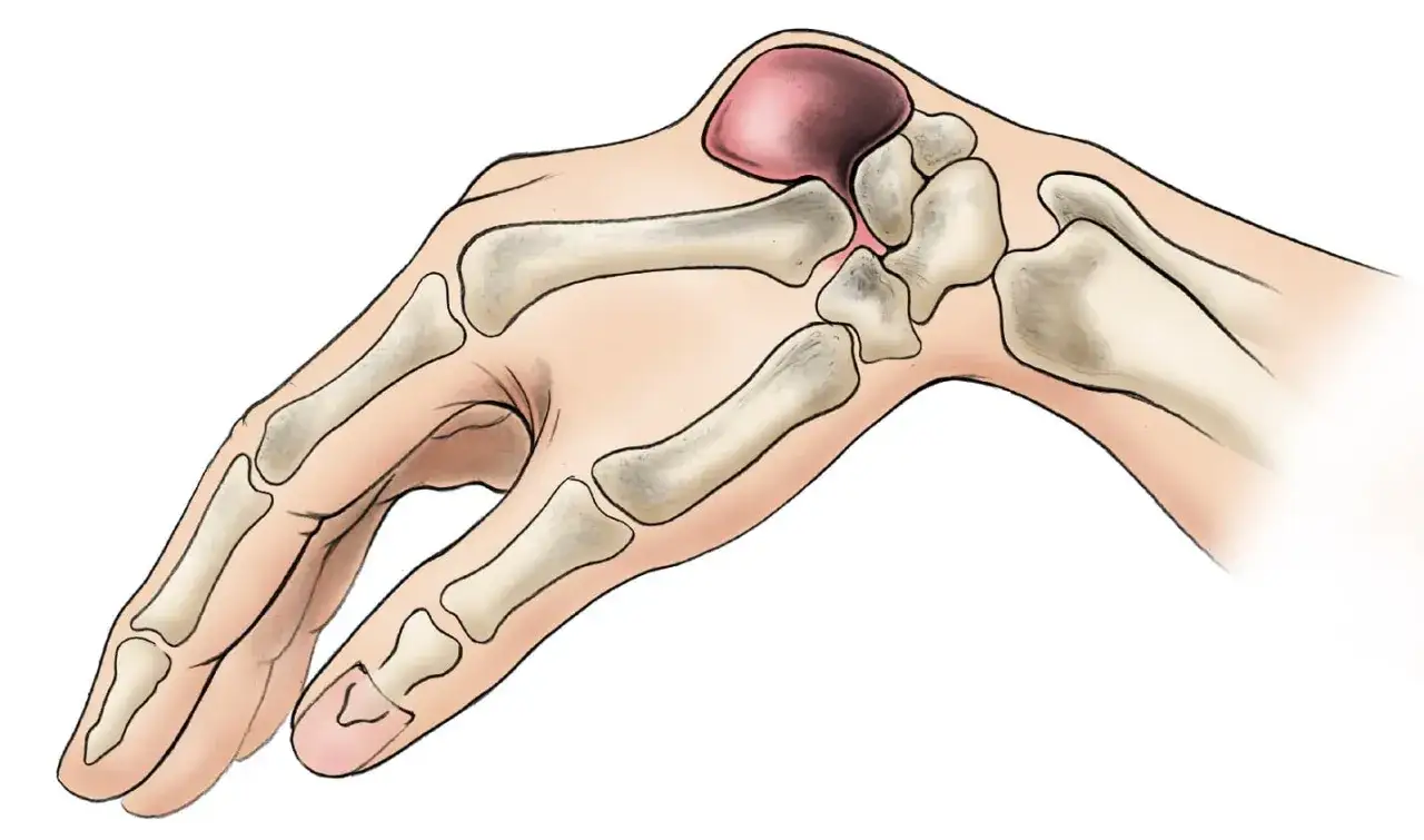 Illustration zeigt ein Handgelenk mit einem Ganglion, einer gutartigen Zyste, die sich aus dem Gelenk oder einer Sehnenscheide bildet.