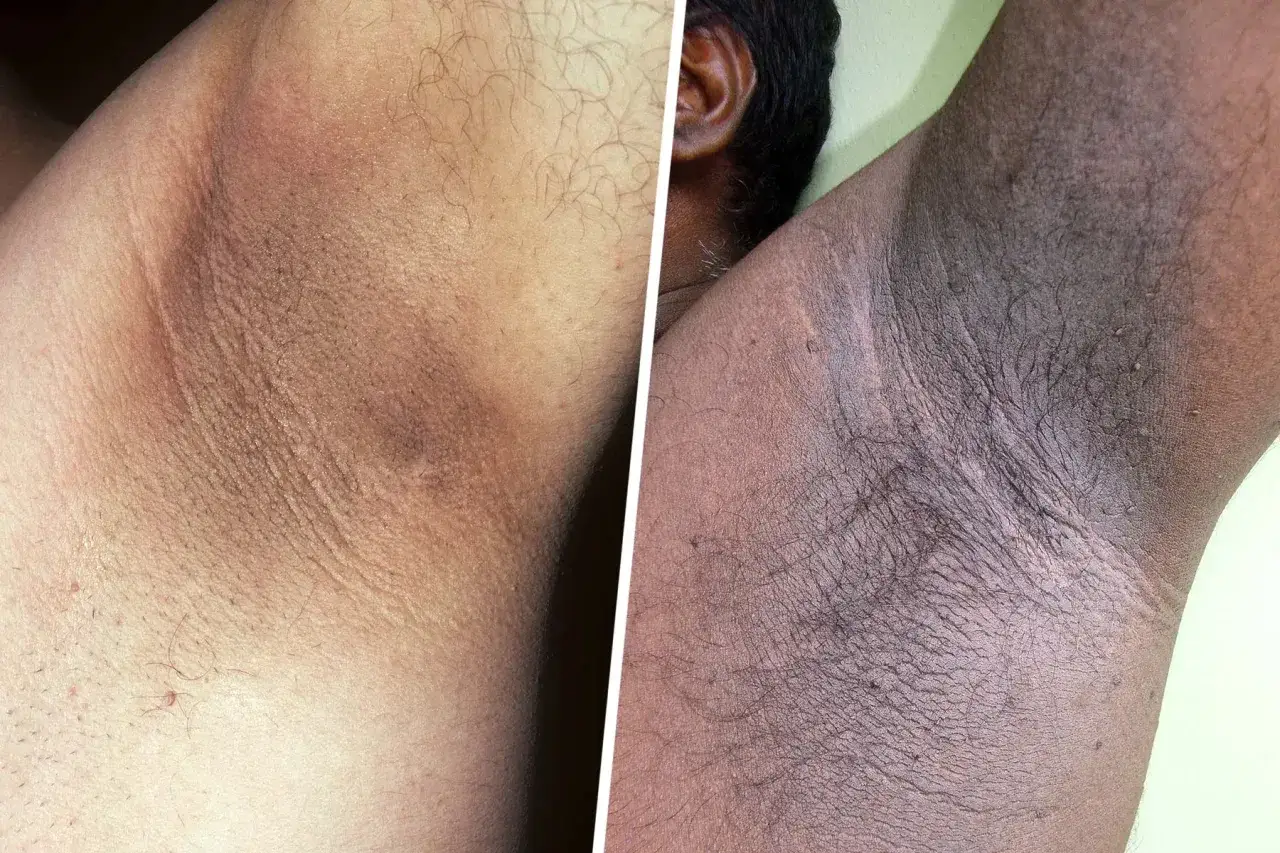 Comparación de axilas: antes y después del acantosis nigricans tratamiento. Piel oscura y engrosada en la axila derecha, más clara en la izquierda.