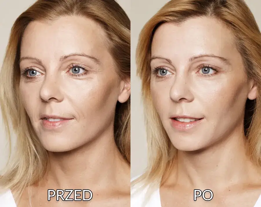 kobieta przed i po kwas hialuronowy sk&oacute;ra nawilżenie