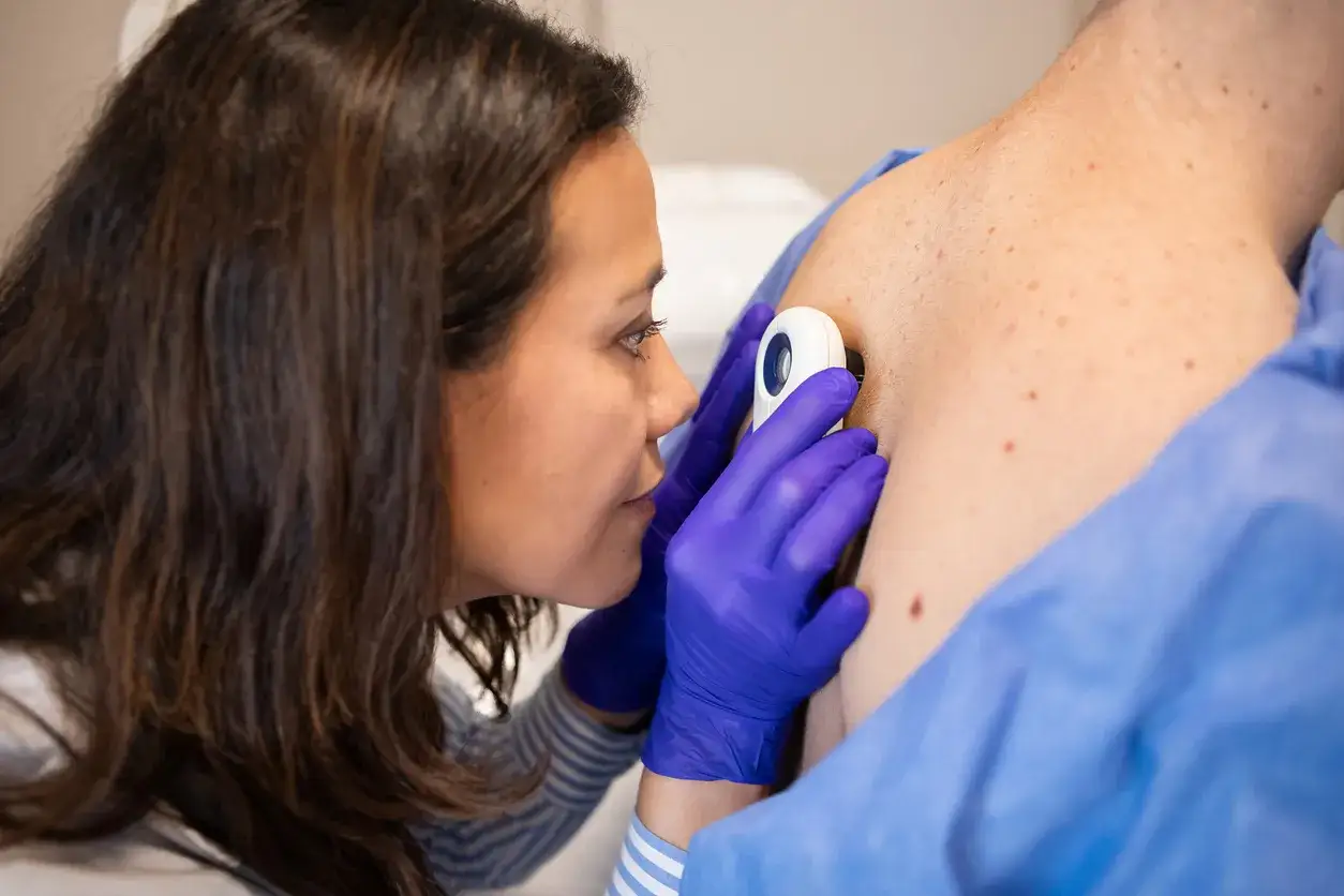 Lekarka bada znamiona pacjenta dermatoskopem. Rozważane jest chirurgiczne usuwanie znamion NFZ.