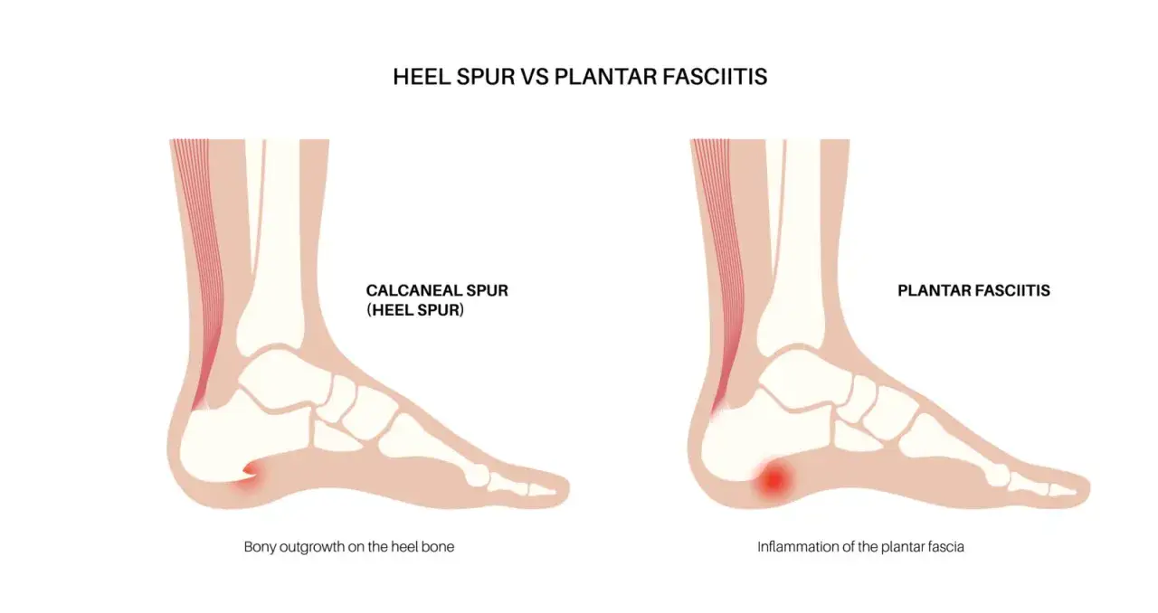 Illustration zeigt Fersensporn (kn&ouml;cherner Auswuchs) und Plantarfasziitis (Entz&uuml;ndung). Ichtholan Salbe kann bei Fersensporn Linderung bringen.