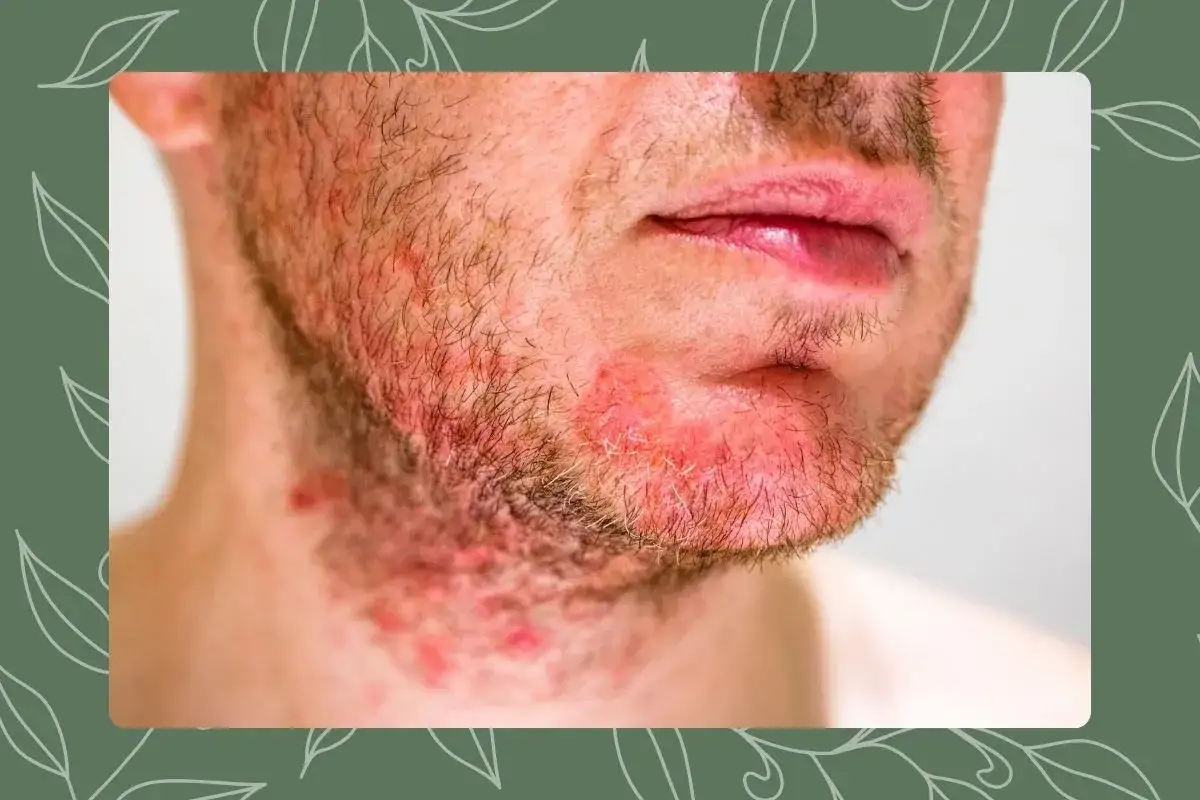 Primer plano de un hombre con granos alrededor de la boca y en la barba, mostrando irritación y enrojecimiento en la piel.