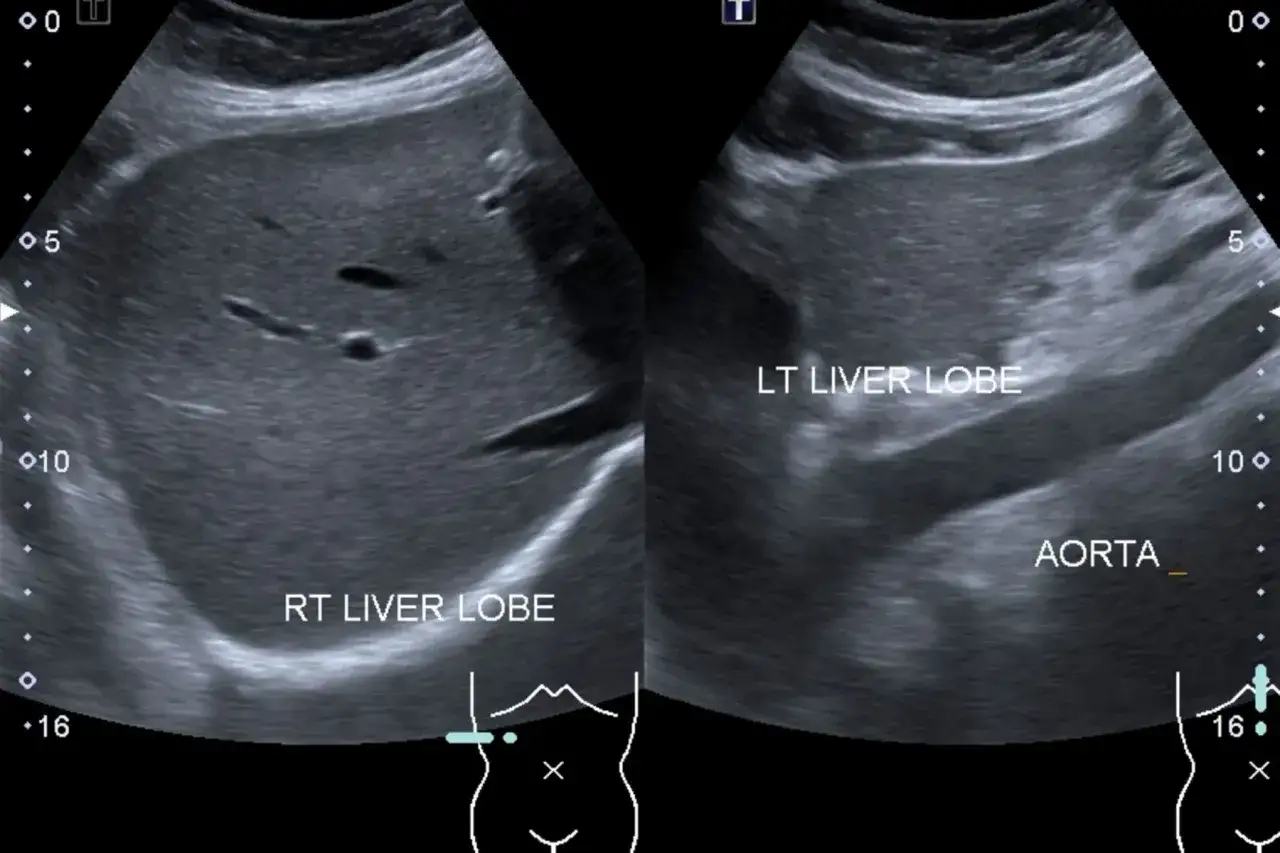 Ultraschallbilder zeigen Leberlappen und Aorta. Mögliche fettleber-symptome wie Schwitzen können hier sichtbar werden.