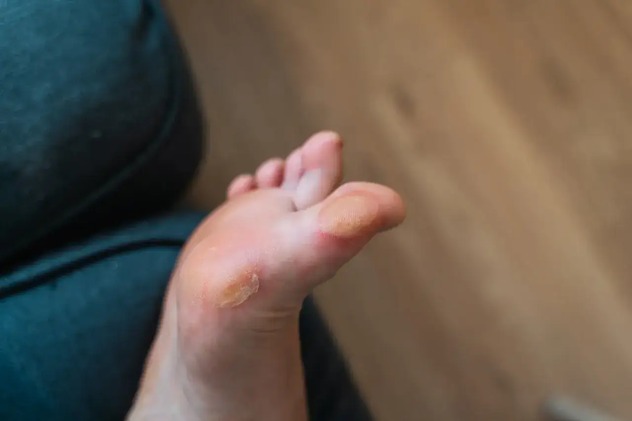 Fußsohle mit deutlicher Druckstelle am Zeh, die auf Reibung durch Schuhe hinweist.