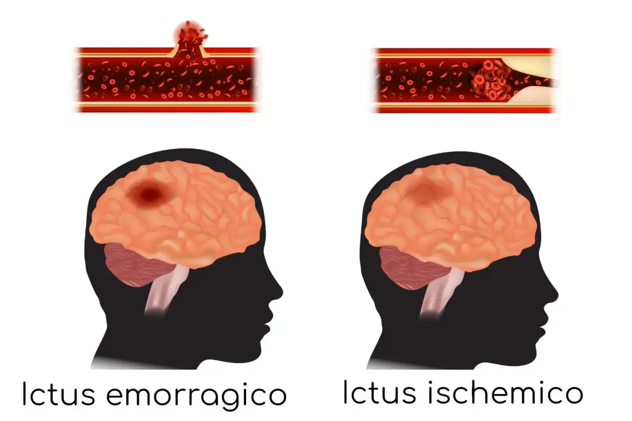 Ictus emorragico e ischemico: il primo causa un sanguinamento nel cervello, il secondo un blocco che pu&ograve; portare a perdita di memoria improvvisa.
