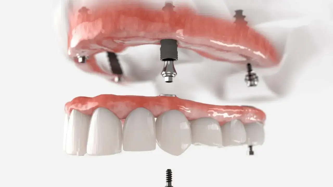 Model szczęki z implantami, pokazujący mocowanie protezy na implantach.