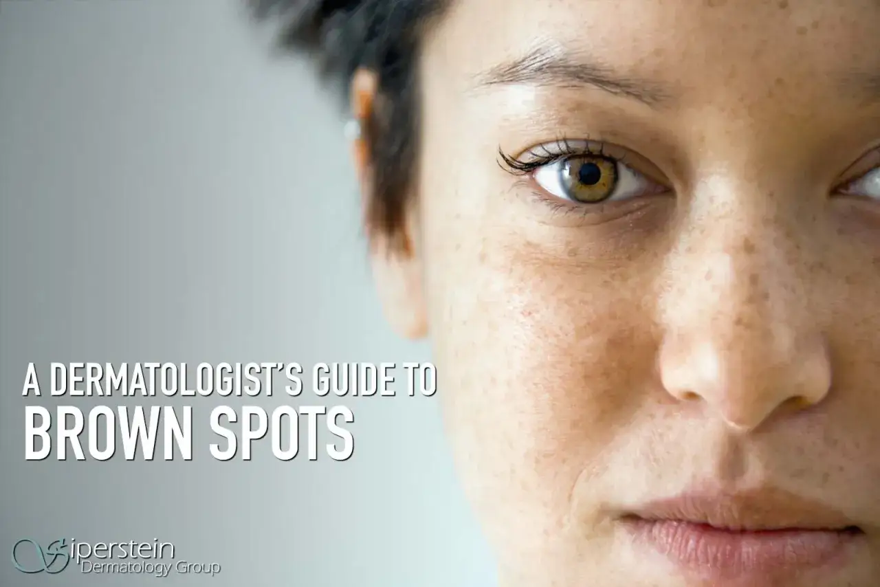 Nahaufnahme eines Gesichts mit vielen braunen rauen Flecken auf der Haut. Text: A Dermatologist's Guide to Brown Spots.