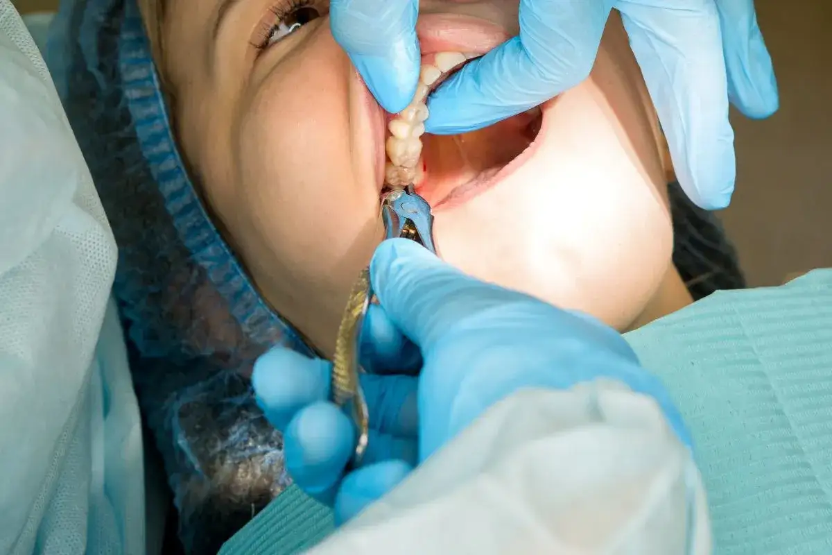 Dentysta wykonuje ekstrakcję zęba, używając kleszczy. Pacjentka ma otwarte usta, a jej twarz jest częściowo zakryta.