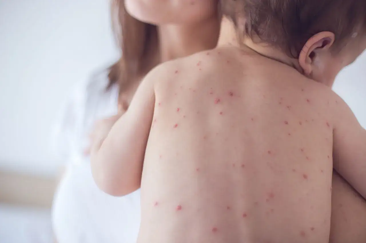 Beb&eacute; con varios tipos de sarpullidos rojos en la espalda, sostenido por una madre.