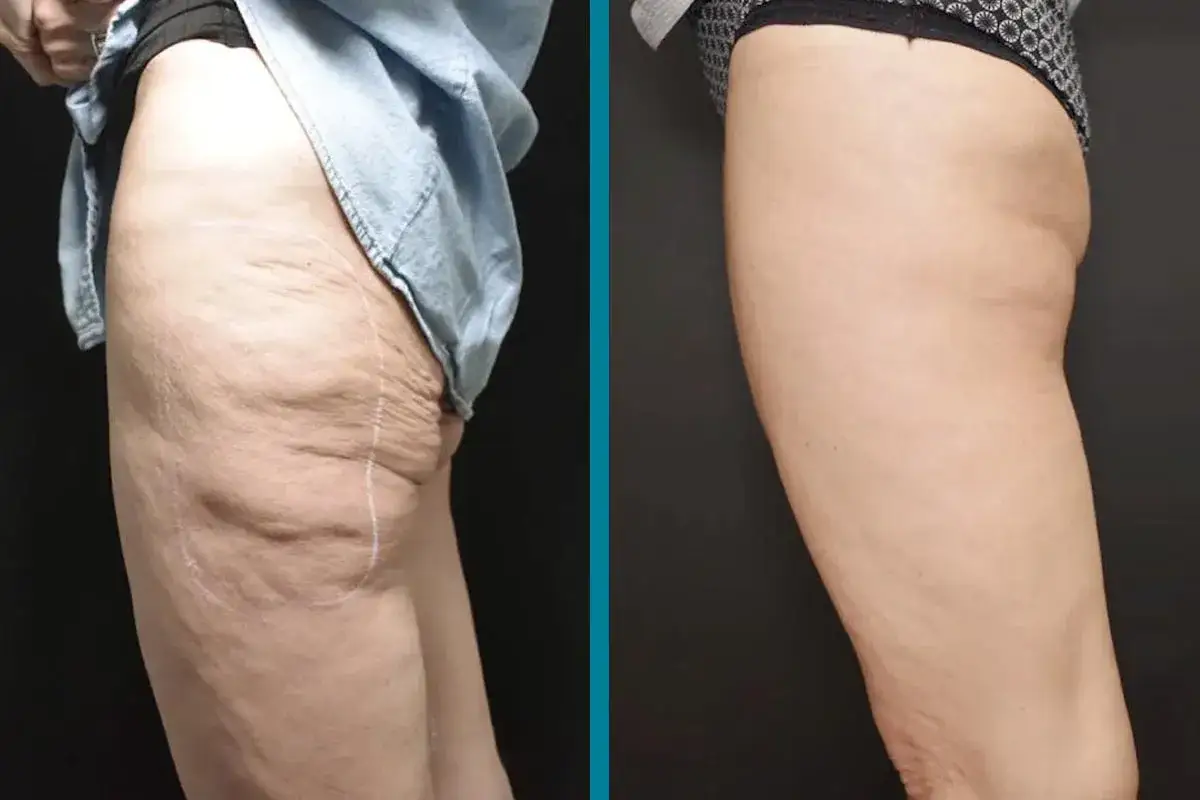 Risultati visibili di radiofrequenza glutei prima e dopo: pelle pi&ugrave; liscia e tonica.