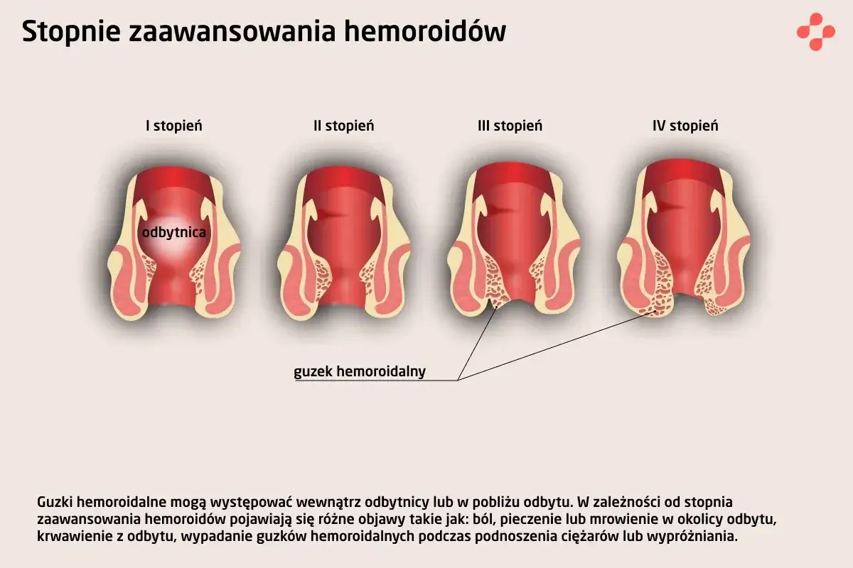 Ilustracja przedstawia cztery stopnie zaawansowania hemoroidów, od I do IV, pokazując rozwój guzków hemoroidalnych.