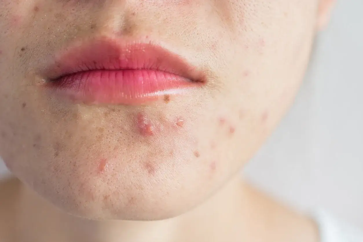 Gros plan sur le bas du visage d'une personne, montrant des boutons de soleil et des imperfections sur la peau autour des lèvres et du menton.