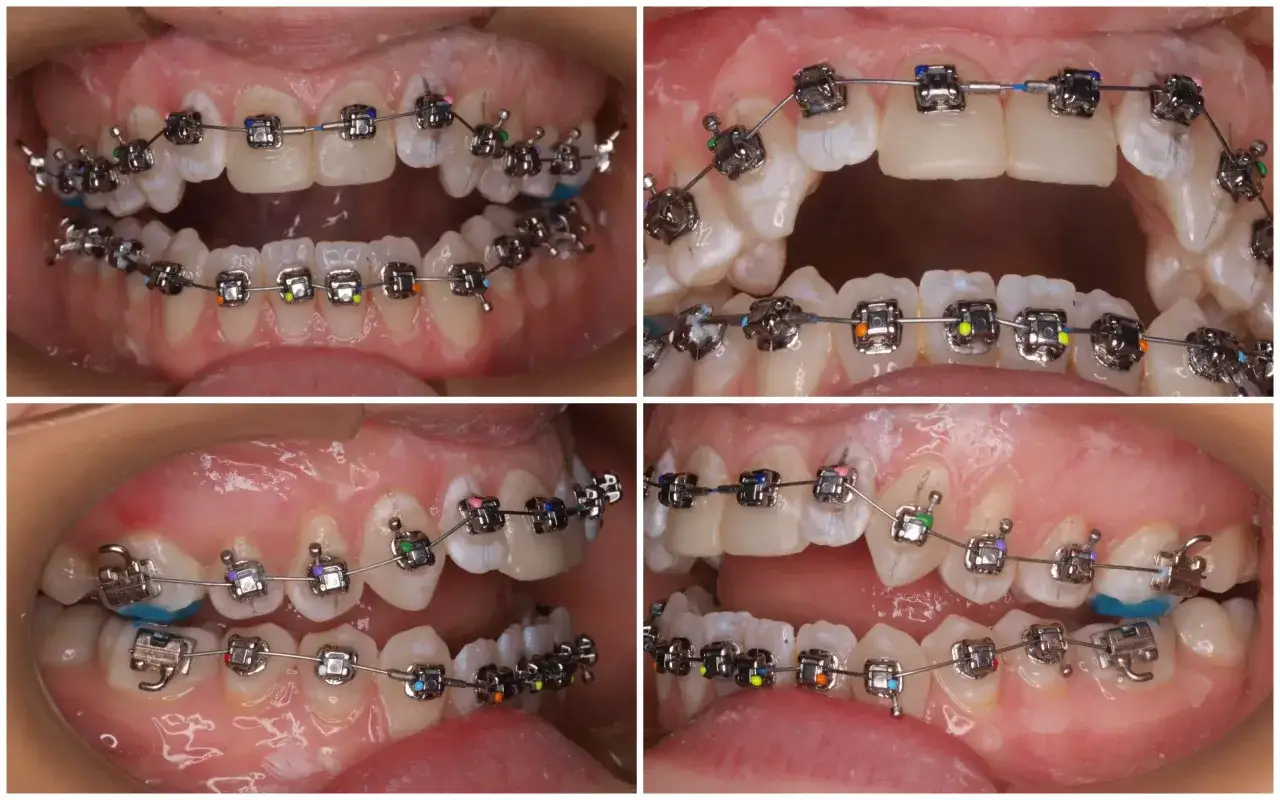 Arcadas dentales con ortodoncia. Se observa una mordida abierta en los dientes frontales, con brackets y alambres de colores.