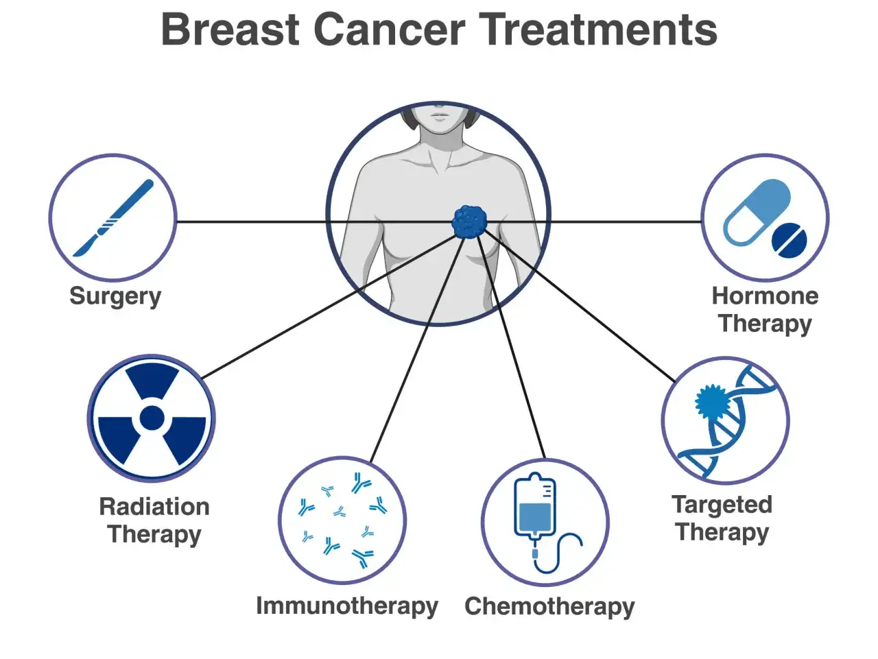 Schema zeigt verschiedene Therapieansätze bei Brustkrebs: Chirurgie, Strahlentherapie, Immuntherapie, Chemotherapie, Hormontherapie und zielgerichtete Therapie.