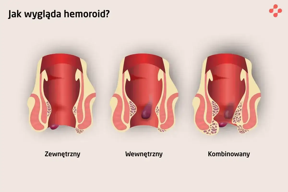 Ilustracja przedstawia trzy typy hemoroidów: zewnętrzne, wewnętrzne i kombinowane. Widoczne są zmiany w obrębie odbytu, które mogą być związane z kłykcinami odbytu i hemoroidami.