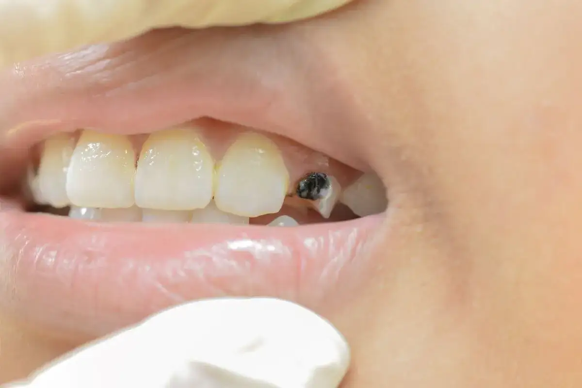 Un diente con un coagulo muela blanco y negro, mostrando caries avanzada.