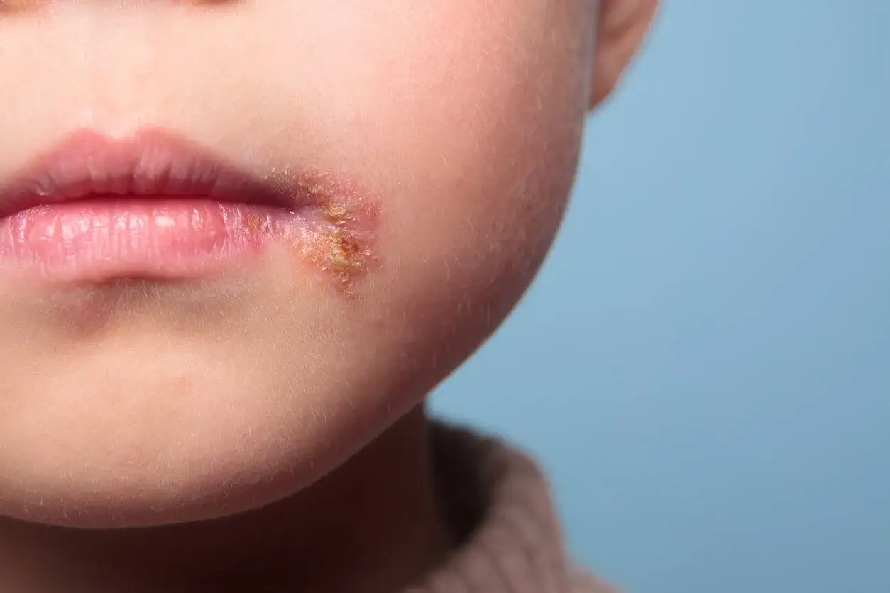 Primer plano de la boca de un niño con una llaga en el labio, con costras amarillentas y piel irritada.