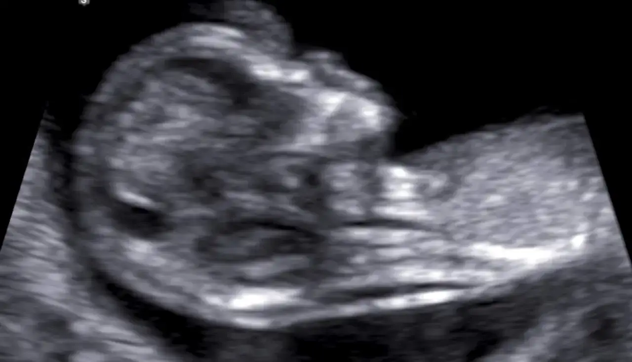 Ultraljudsbild visar ett fosterhuvud med en ökad nackspalt, vilket kan vara ett tecken på Downs syndrom.