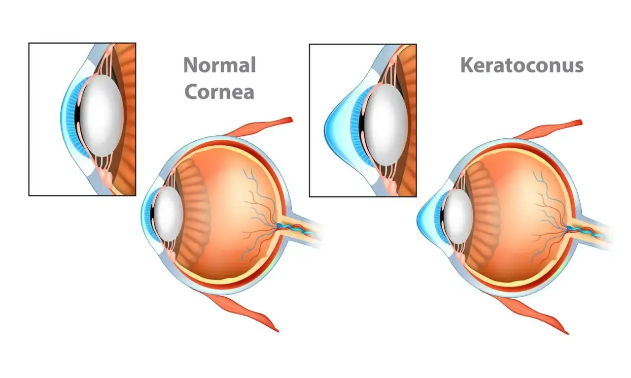 Confronto tra cornea normale e occhio con cheratocono. La cornea normale &egrave; sferica, mentre nel cheratocono si deforma a cono.