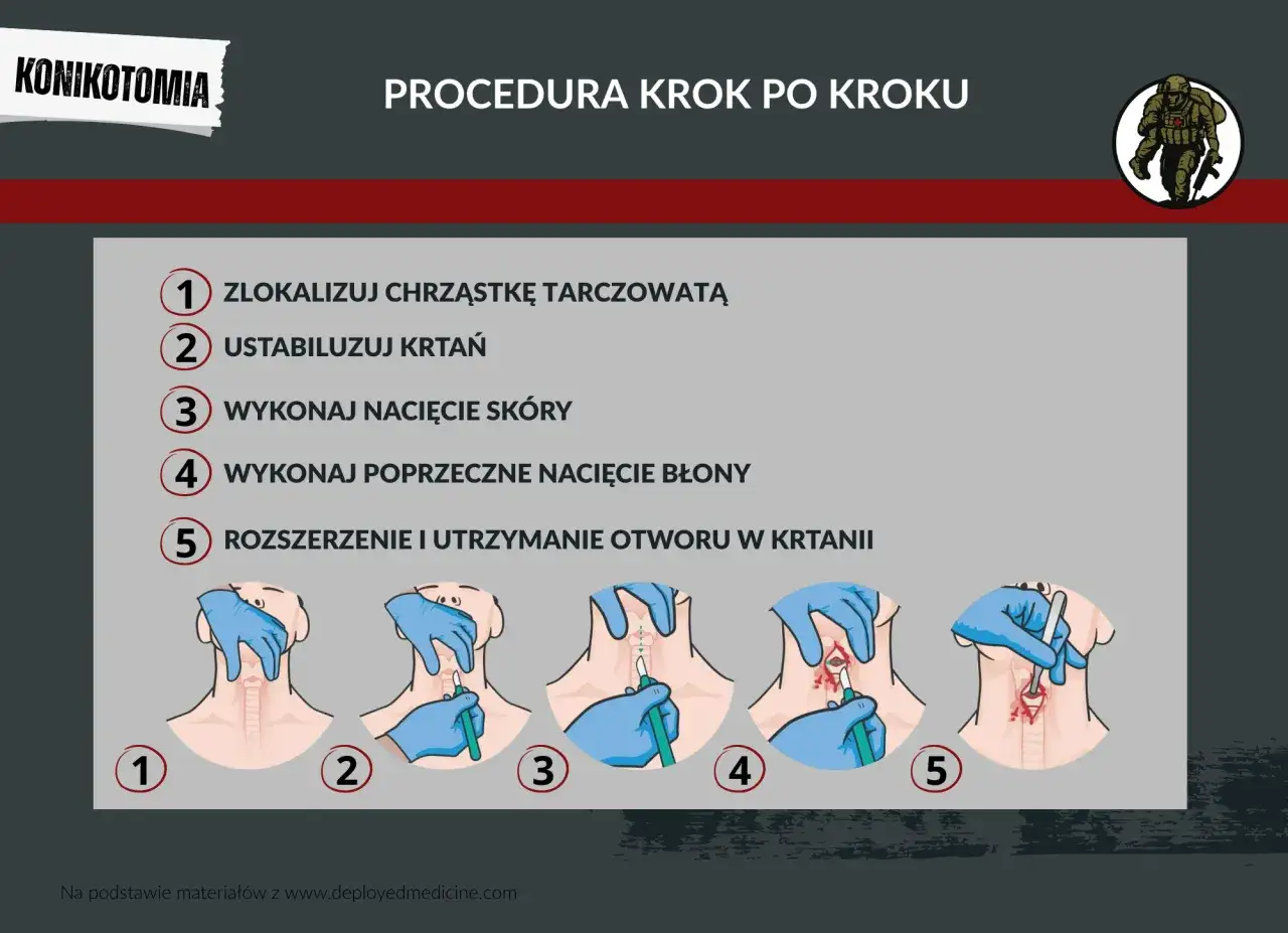 Ilustracja przedstawia procedurę konikotomii ratunkowej krok po kroku: lokalizacja chrząstki, stabilizacja krtani, nacięcie skóry, nacięcie błony i rozszerzenie otworu.