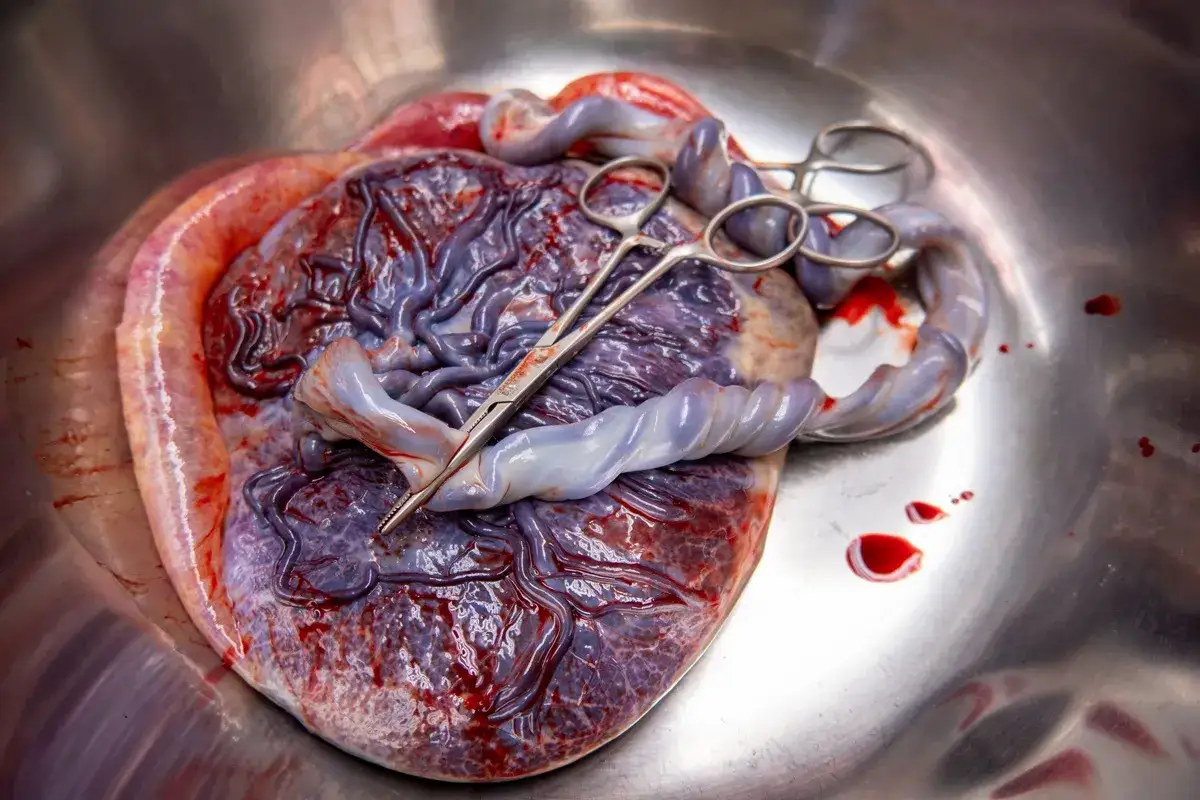 Placenta z pępowiną i klemami w metalowej misce. Widać żyły i naczynia krwionośne.