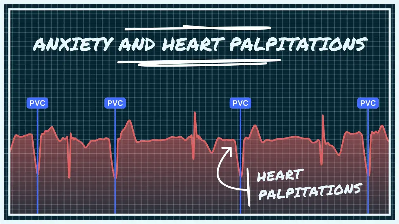 Wykres EKG z oznaczeniami PVC i 