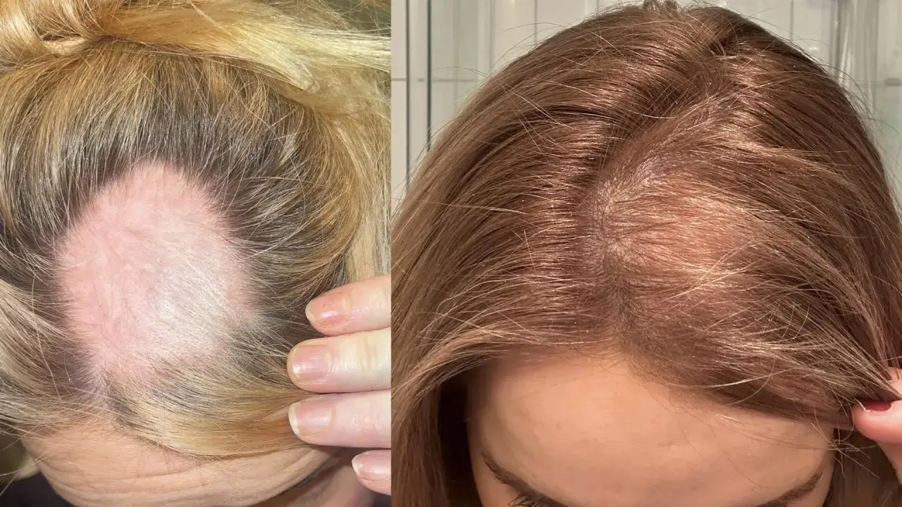 F&ouml;re och efter bilder visar h&aring;rv&auml;xt efter alopecia areata behandling.