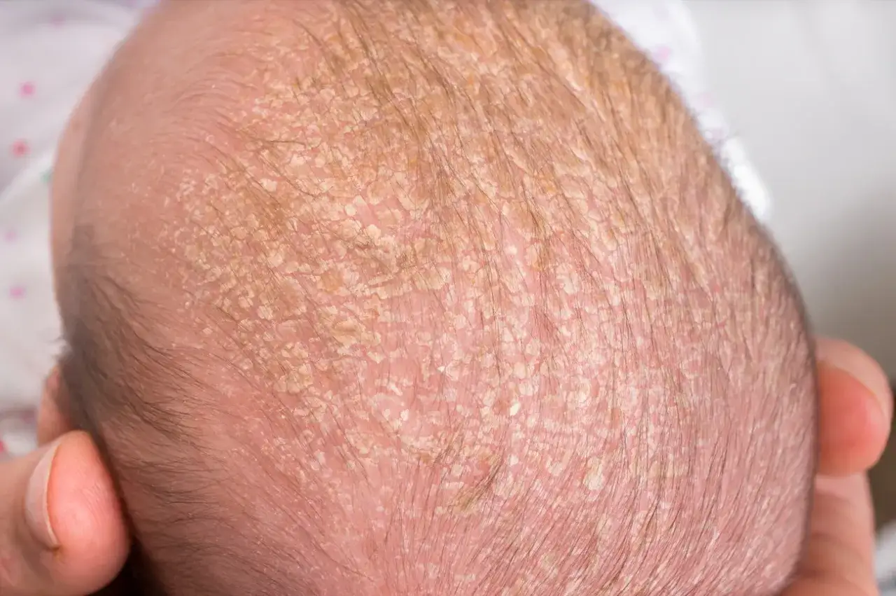 Cute baby's head with flaky skin, a common sign of croûte d'un bébé. The fine hair is visible amidst the patches.