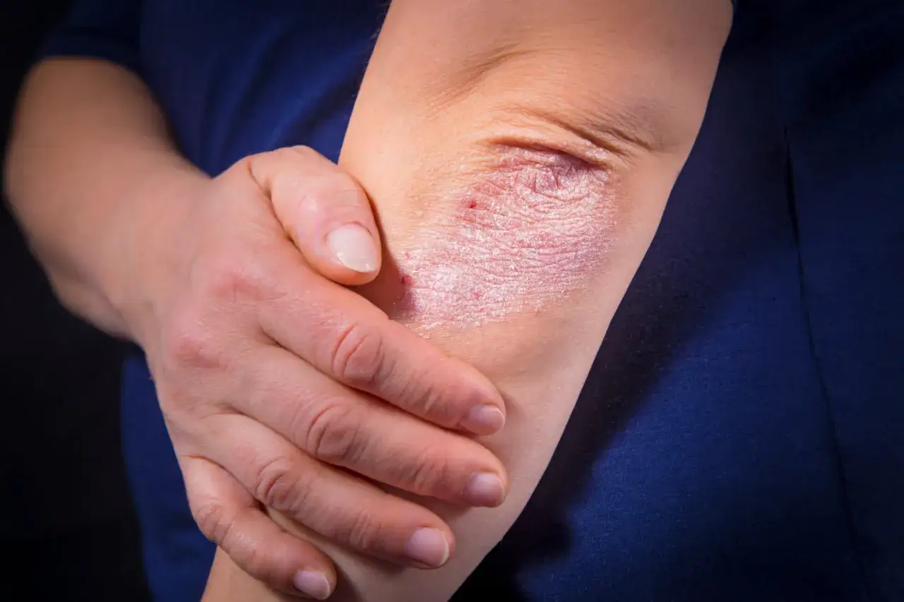 Łokieć z łuszczycą, objawy choroby. Szukasz najlepszej kliniki leczenia łuszczycy?