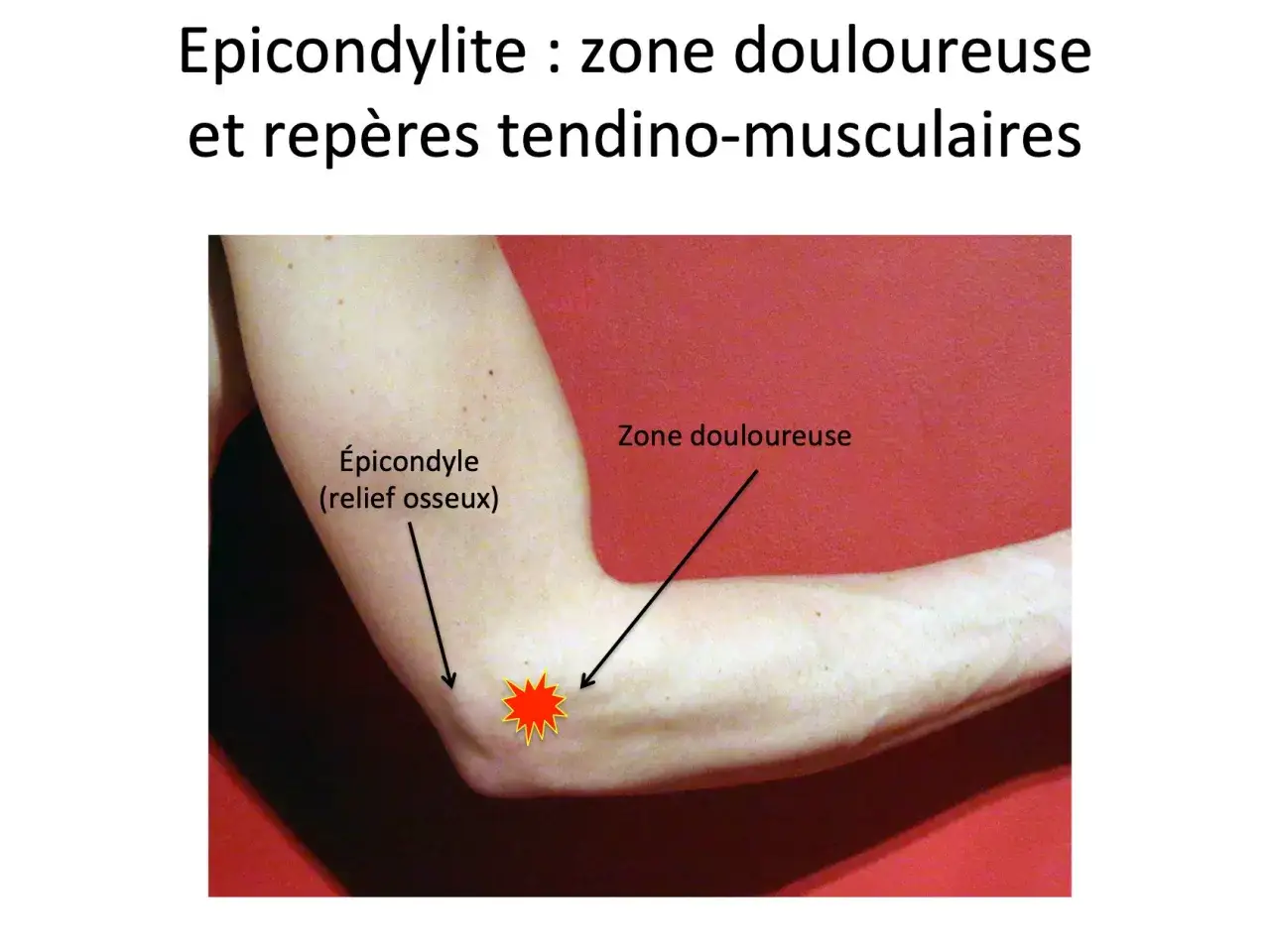 Coude douloureux, montrant l'&eacute;picondyle et la zone sensible de l'&eacute;picondylite.