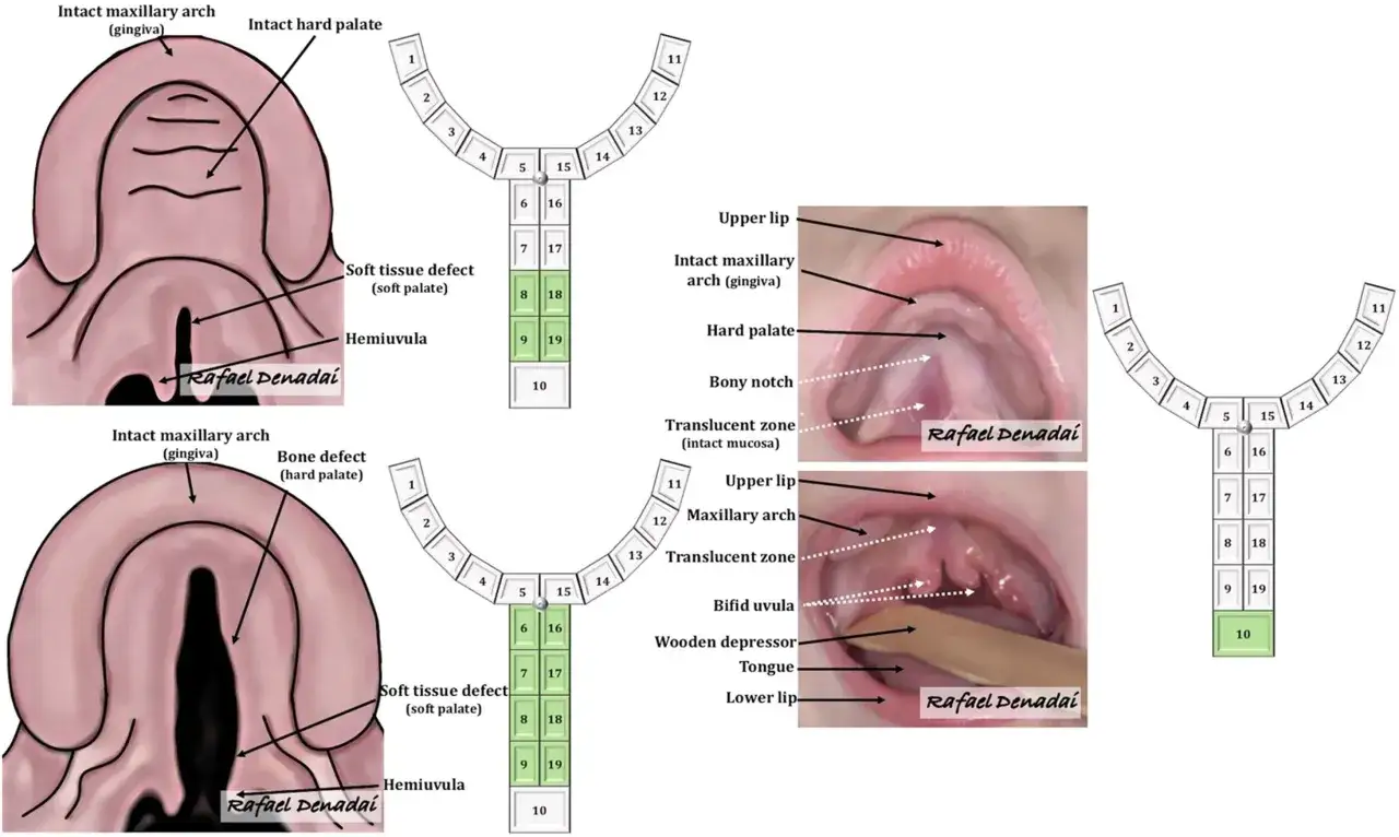 Ilustraci&oacute;n y fotos de un beb&eacute; con un agujero en el paladar, mostrando la anatom&iacute;a y defectos.