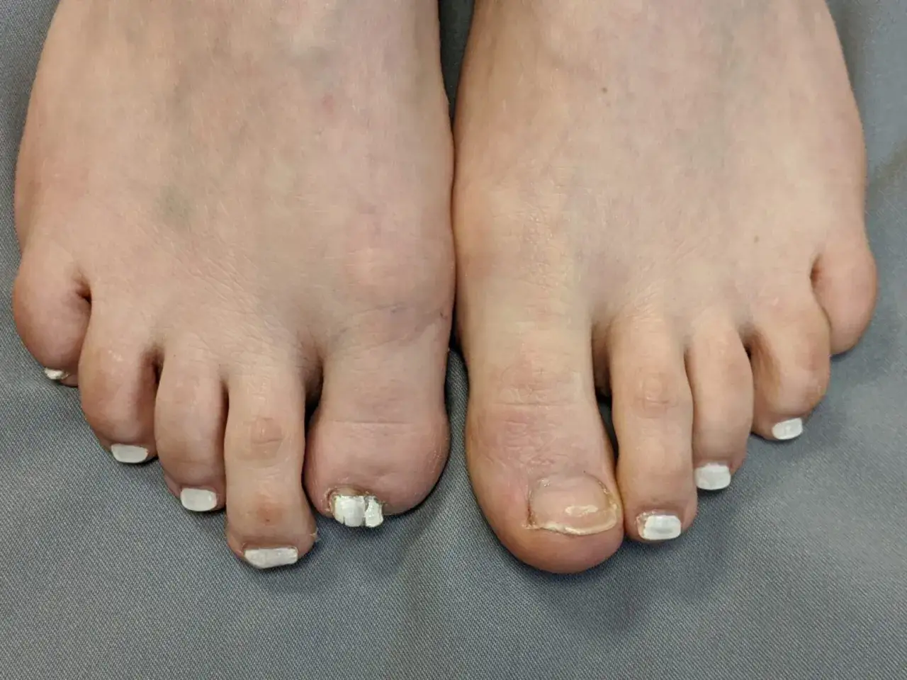 Piedi con un alluce sinistro amputato e una protesi visibile. L'alluce destro è intatto.