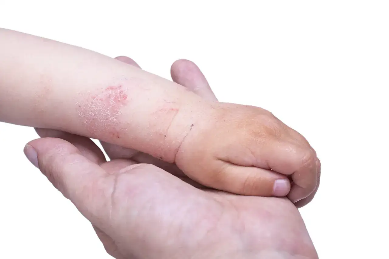 Mano di adulto che tiene il braccio di un neonato con pelle screpolata e arrossata, segno di dermatite.